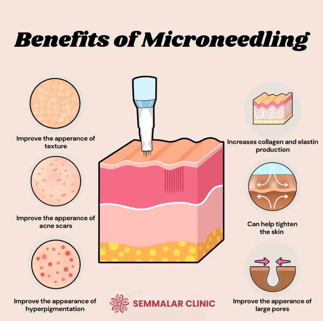 Benefits of Micro Needling Treatment In Chennai
